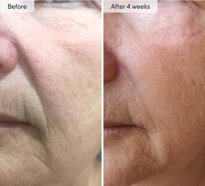 Micro-Infusion Targeted Patches