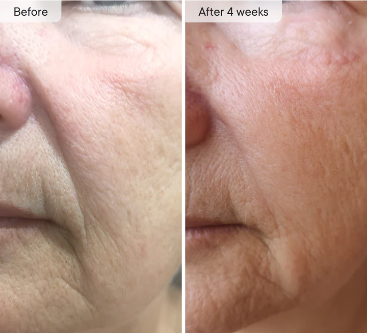 Micro-Infusion Targeted Patches