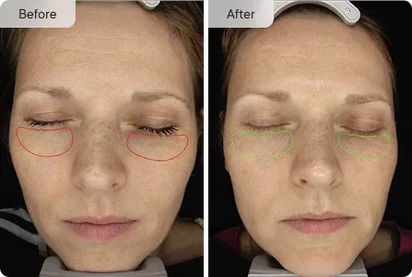 Micro-Infusion Targeted Patches