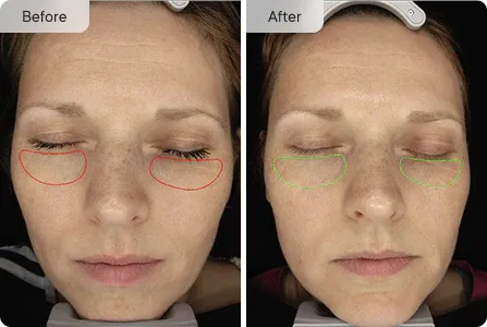 Micro-Infusion Targeted Patches