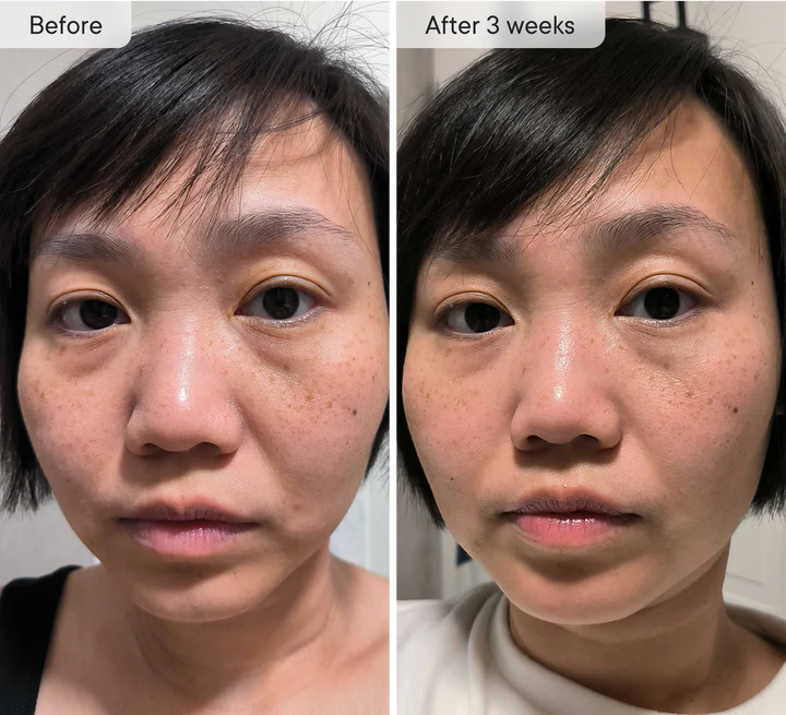 Micro-Infusion Targeted Patches