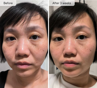 Micro-Infusion Targeted Patches