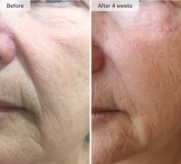 Micro-Infusion Targeted Patches