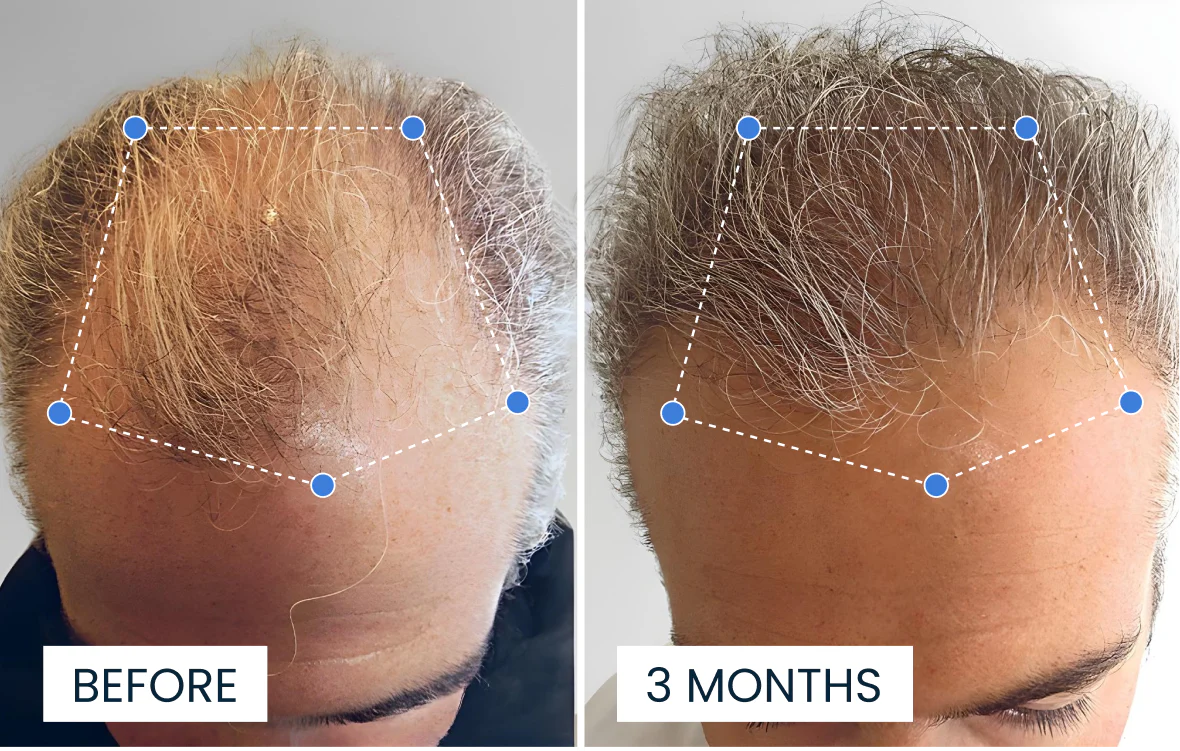 Advanced Hair Growth Roll-On Serum