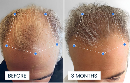 Advanced Hair Growth Roll-On Serum