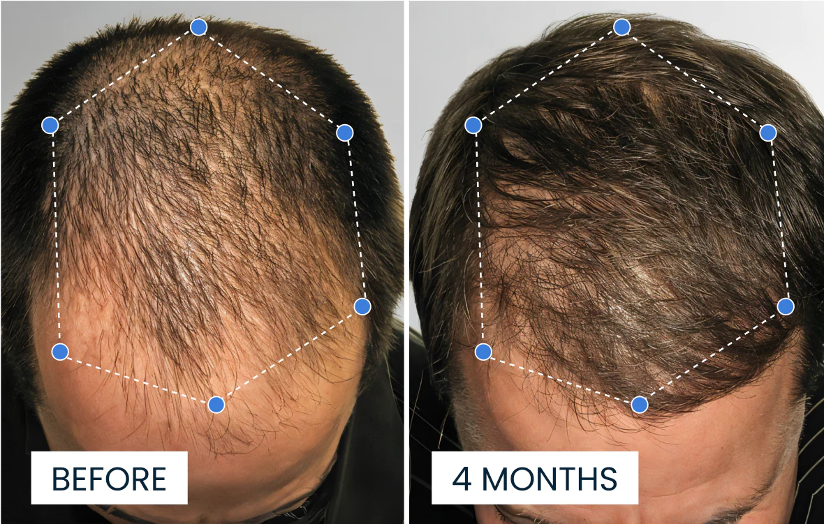 Advanced Hair Growth Roll-On Serum