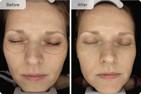 Micro-Infusion Targeted Patches